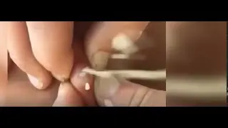 SLOW MOTION PIMPLE POPPING #shorts