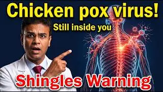 Shingles: Chicken pox is gone but virus is still inside you!!