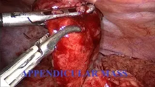 Appendicular mass| Acute Appendicitis| Laparoscopic appendectomy| Dr. Pandiaraja