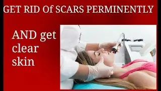 hOw to get rid of acene scars PERMINENTLY