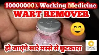 लटकते मस्सों / चामखीळ को निकालने की आयुर्वेदिक दवा | Wart Remover / Best Wart Remover