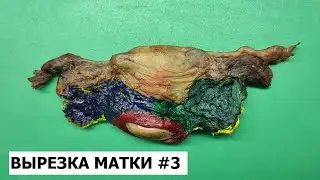 Гистологическое исследование (вырезка) матки #3  - рак шейки матки