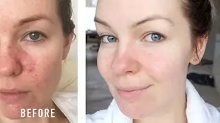 HOW I CURED MY ROSACEA // IRRITATION // REDNESS // MY STORY