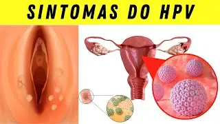 SINTOMAS DA HPV E QUAL TRATAMENTO MAIS ADEQUADO