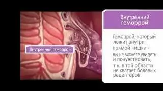 ЛЕЧЕНИЕ ГЕМОРРОЯ - самый эффективный метод.