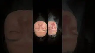 Revision Rhinoplasty for Severely Crooked Nose in Turkey Before After (Allogenic Rib Cartilage Used)
