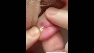 выдавили из уха