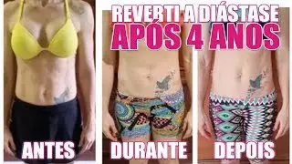 Reverti a Diástase depois de 4 anos: Quanto vale isso pra você? Pós Parto em Forma