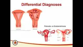 Early diagnosis and management of endometriosis for family practice and outpatient gynaecology