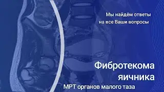 Фибротекома