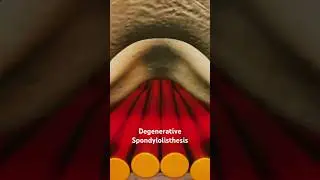 Degenerative Spondylolisthesis