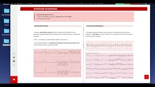 Arrhythmia, Flutters & fibrillations