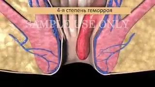 Лечение ГЕМОРРОЯ. Степени геморроя.