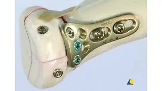 ProximalRadius Fractures,  Radial Head Plate