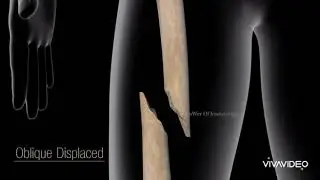 Nurses Zone(documentary)-by-Chipo James Mainda=Types of bone fracture