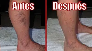 REMEDIOS CASEROS PARA LAS VARICES