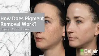 How does Fraxel work for pigmentation?