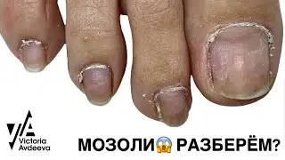 КОВЫРЯЕМ МОЗОЛИ В ПРЯМОМ ЭФИРЕ.  Виктория Авдеева