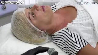 Фракционное омоложение в адам и ева