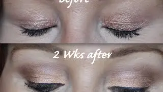 Plexr Plasma Fibroblast Hooded Eye Treatment - Part 2 - Non surgical Blepharoplasty?