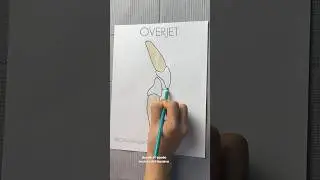 Overbite y overjet en odontología #overbite #overjet #odonto #oclusiondental