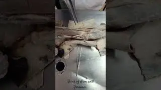 Veins of Arm and Forearm