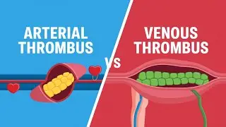 Arterial vs Venous Thrombus || General Pathology || Pathology Past Papers || Robbins || Hemodynamics