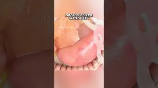 Endoscopic Sleeve Gastroplasty (3D Animation)