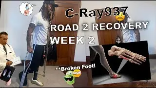 Broken Foot Recovery - Week 2
