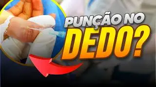 ACESSO VENOSO NO DEDO! VEJA AGORA!