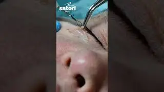 Удаление папиллом электрохирургическим методом 