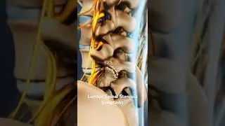 Lumbar Spinal Stenosis Symptoms