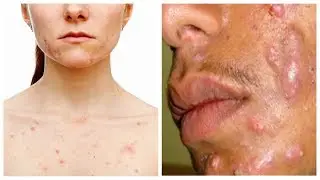 Прыщи (угри, акне) и их лечение