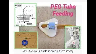 PEG Tube Feeding | How To Prepare The Feeding | Percutaneous Endoscopic Gastrostomy Tube