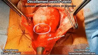 Cure de prolapsus - sacrospinofixation de RICHTER /vaginal prolapse- sacrospinous ligament fixation