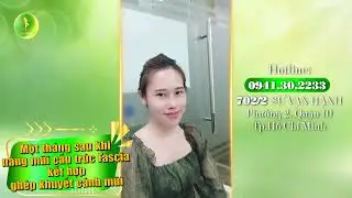 Một tháng sau khi nâng mũi cấu trúc Fascia kết hợp ghép khuyết cánh mũi