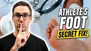 🦶BEST 9 Athlete's Foot Fungus Remedies [& the #1 Big Mistake]🦶