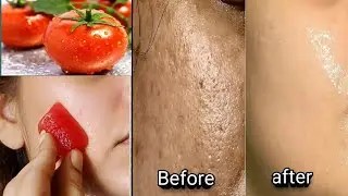 Rub this on your face daily to get smooth poreless fair skin-get rid of open pores,oily & Dark skin
