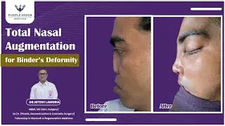 Precision Redefined: Total Nasal Augmentation for Binder’s Deformity