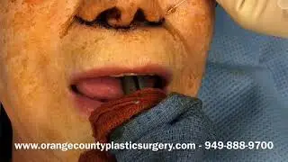 Lip Lift at Orange County Plastic Surgery