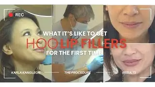 GETTING LIP FILLERS FOR THE FIRST TIME