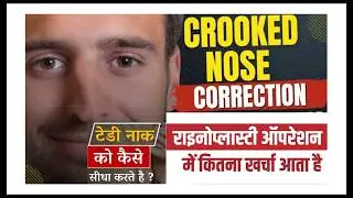 टेढ़ी नाक की प्लास्टिक सर्जरी का खर्चा I CROOKED NOSE SURGERY I DEVIATED NOSE SURGERY IN DEHRADUN