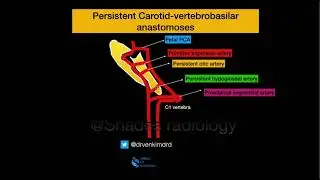Persistent Embryonic arteries