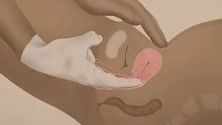 The Bimanual Exam (Health Workers), French - Family Planning Series