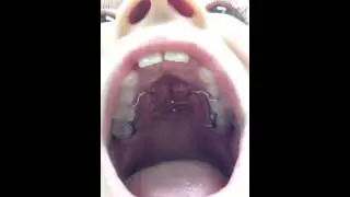 Palatal Expander: Getting Braces On: Nirenblatt Orthodontics