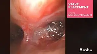 Valve Placement  | Dr. John Hinze Using the aScope 5  Broncho HD