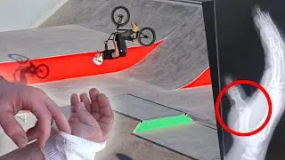 SE ROMPE EL DEDO EN EL NUEVO SKATEPARK!