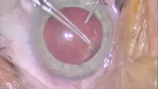 Cataract Surgery: No Rotation Perfect Plus Sculpting by Dr. Shawn Cohen