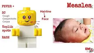 Measles