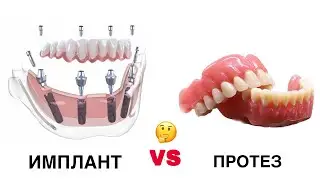 ИМПЛАН еки ПРОТЕЗ кадомиш хуб?
